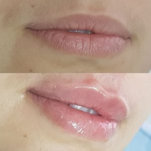 procedimento-labial-preenchimento-bb-lips_1119_1400x1400